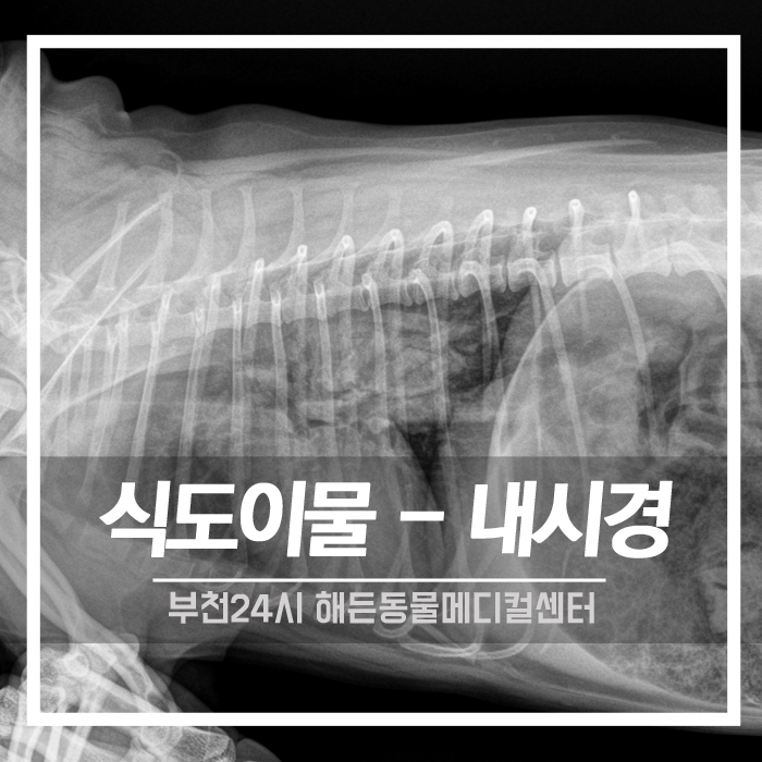 [내과] 식도이물 내시경 (고구마섭취 후 호흡곤란)